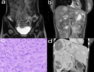 Liver transplantation combined with tyrosine kinase inhibitors for the treatment of hepatic metastatic giant gastrointestinal stromal tumors: A case report and literature review